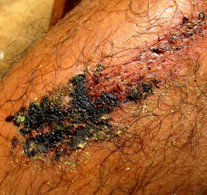 Gumbo-Limbo, Naked Indian, or BURSERA SIMARUBA, scrape wound treated medicinally with sap