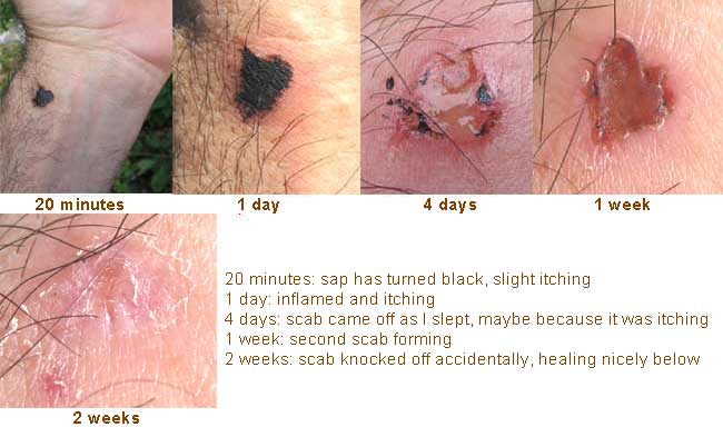 Effects of Poisonwood, METOPIUM BROWNEI, on my skin